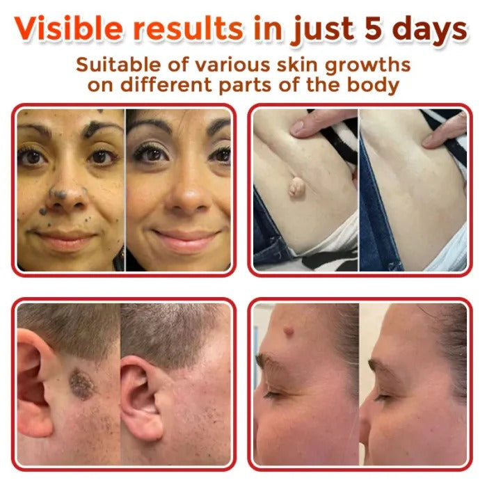 BelBexa™️ ClearTag Microneedle Skin Tag Patch (🔥Buy 1 Get 1 Free🔥)
