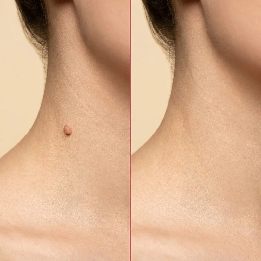 BelBexa™️ ClearTag Microneedle Skin Tag Patch (🔥Buy 1 Get 1 Free🔥)